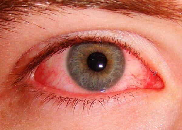 Аллергический конъюнктивит - состояние, когда воспаляется соединительнотканная оболочка (конъюнктива), которая покрывает глаз и веко изнутри.