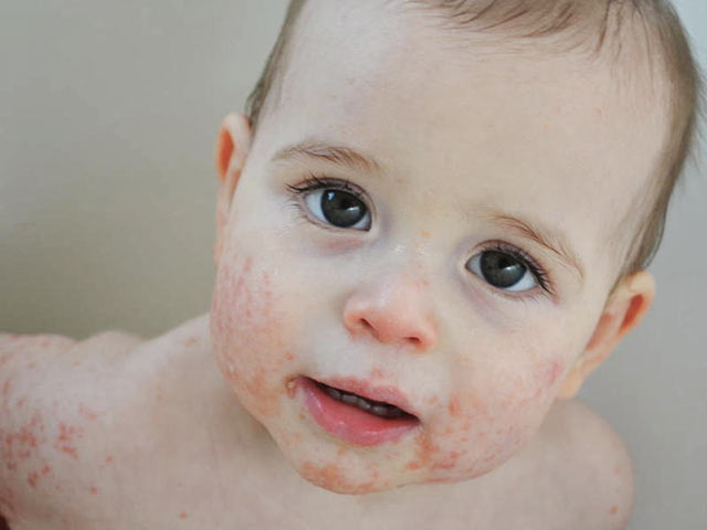 Основная причина атопического дерматита у детей – специфическая реакция иммунной системы на внешние и внутренние раздражители.